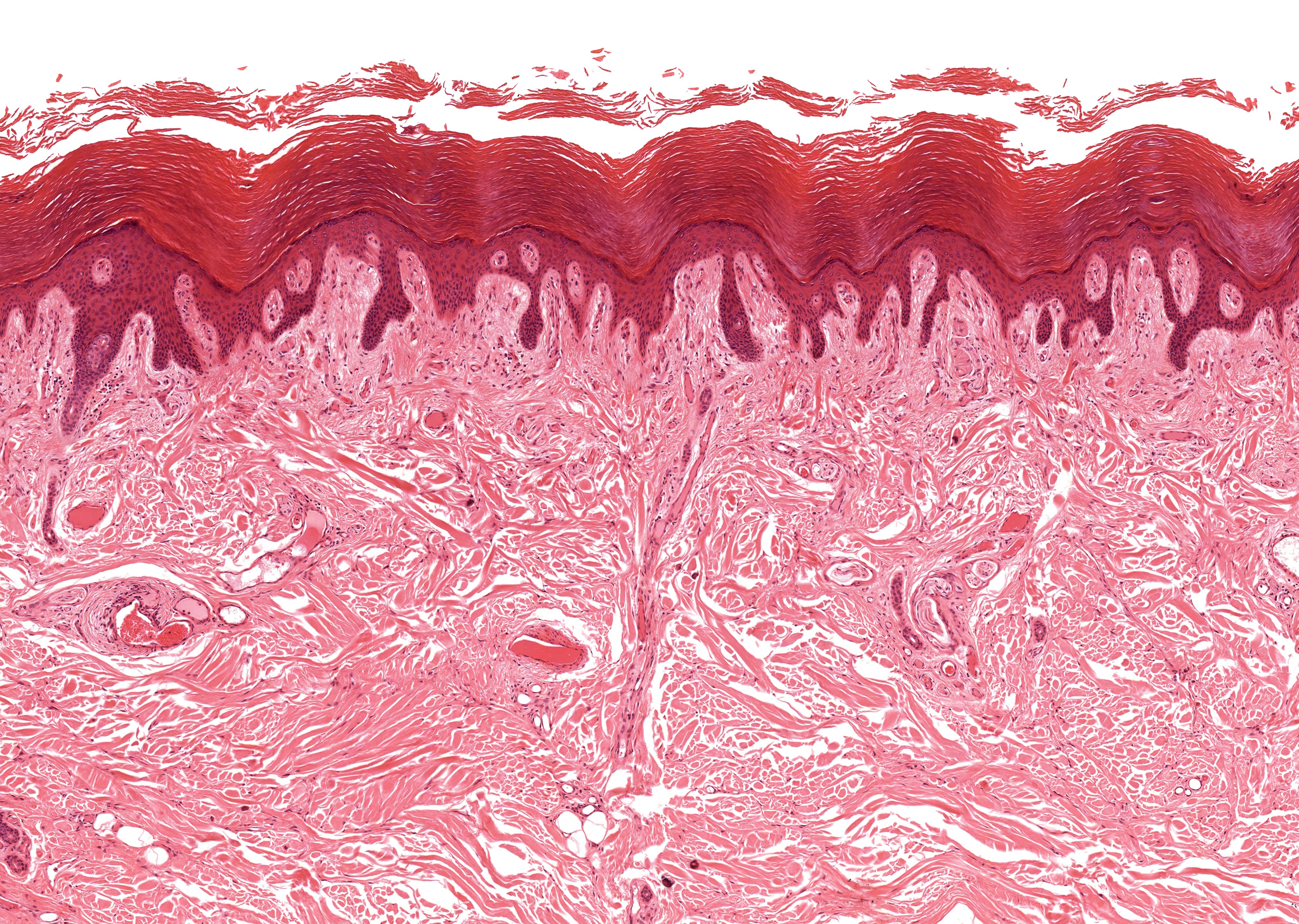 Psoriasis Bilimi ile Cilt Altında